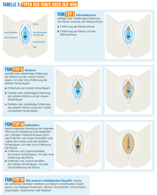 Übersichtstabelle der FGM-Typen als Grafik